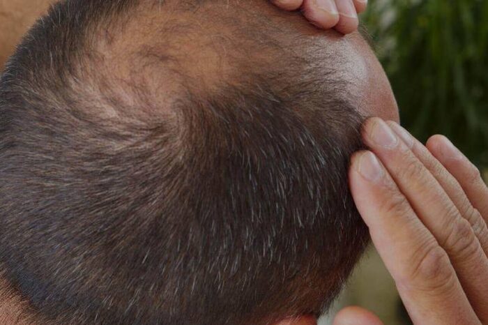 Hair loss treatment in Rahata, Ahmednagar