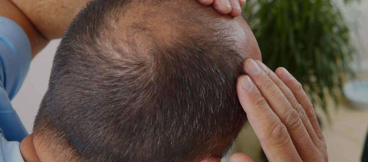 Hair loss treatment in Rahata, Ahmednagar